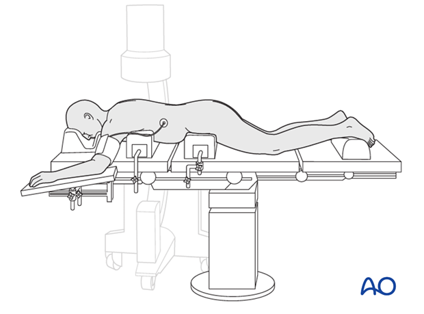 preparation posterior procedures