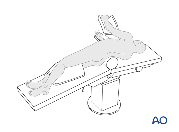 anterior approach to the lumbar spine