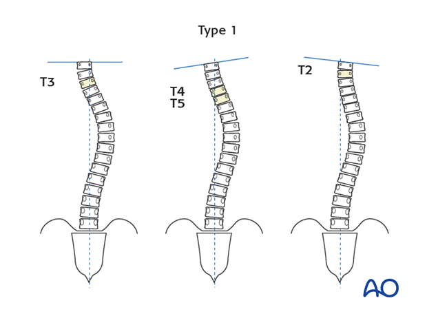 selection of fusion level