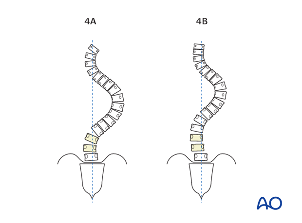 selection of fusion level