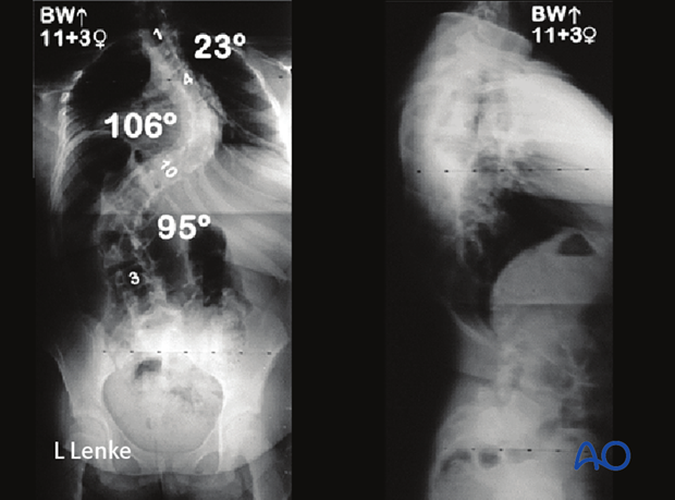 immature patients abnormal neuroaxis body habitus