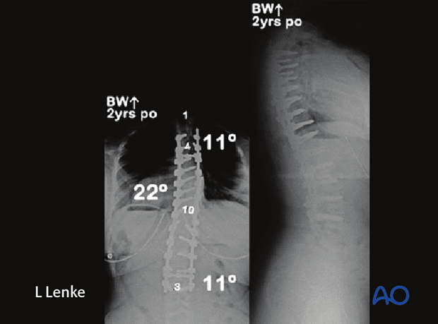 immature patients abnormal neuroaxis body habitus