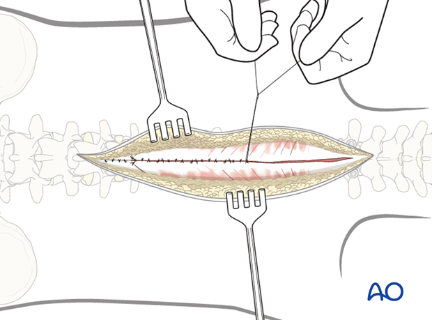 posterior approach