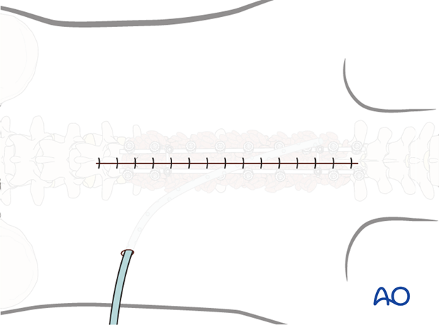 posterior approach