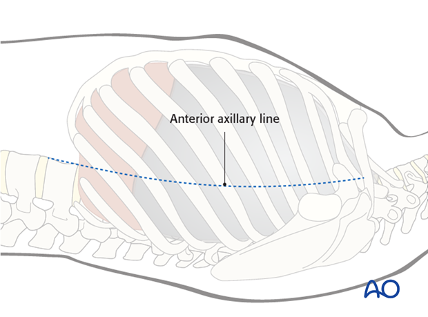 anterior thoracoscopic release