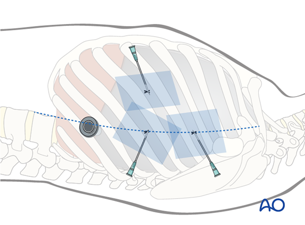 anterior thoracoscopic release