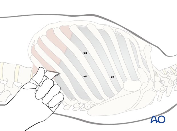 anterior thoracoscopic release