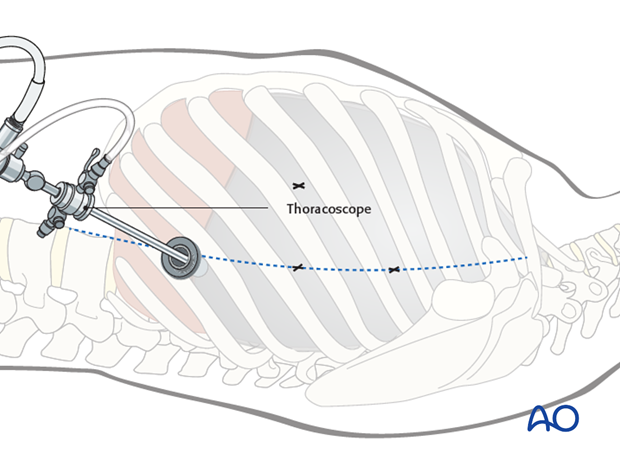 anterior thoracoscopic release