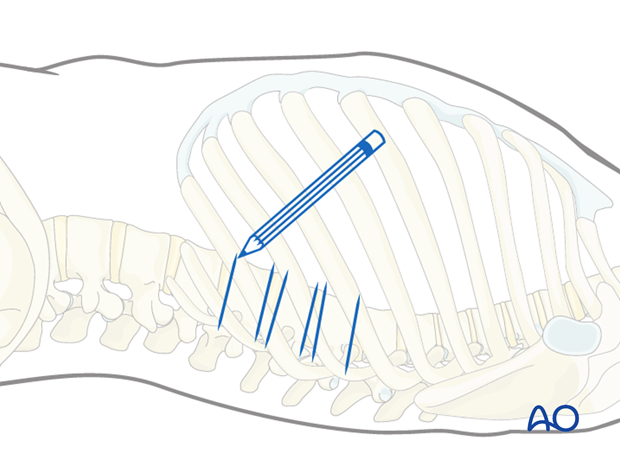 minimally invasive left side thoracic approach