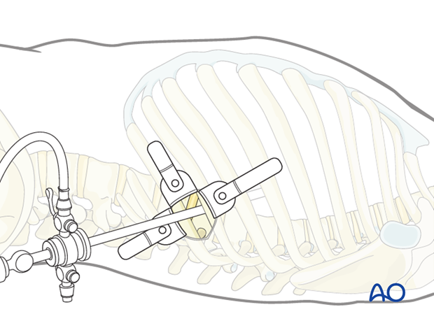 minimally invasive left side thoracic approach