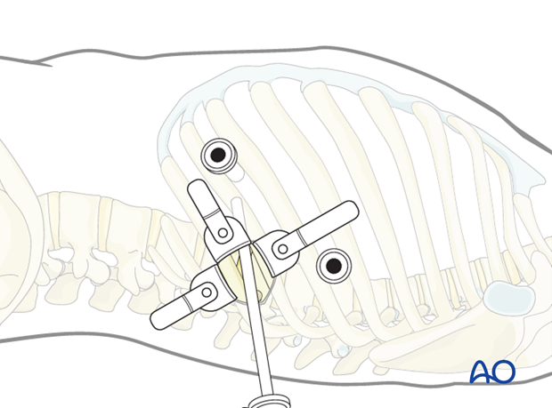 minimally invasive left side thoracic approach