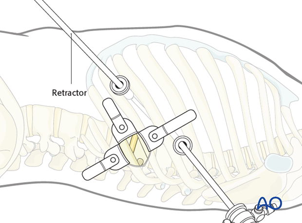 minimally invasive left side thoracic approach