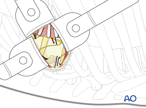 minimally invasive left side thoracic approach