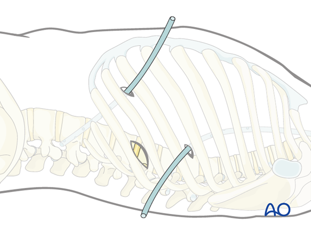 minimally invasive left side thoracic approach