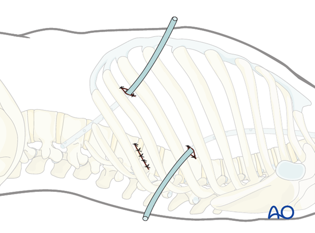 minimally invasive left side thoracic approach