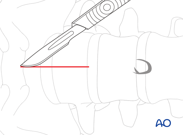 retroperitoneal approach