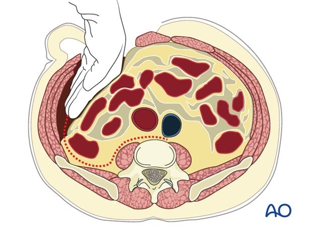 retroperitoneal approach