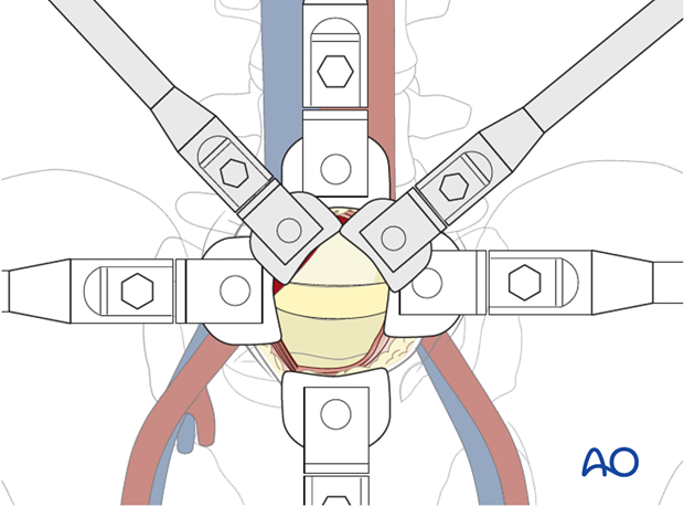 retroperitoneal approach