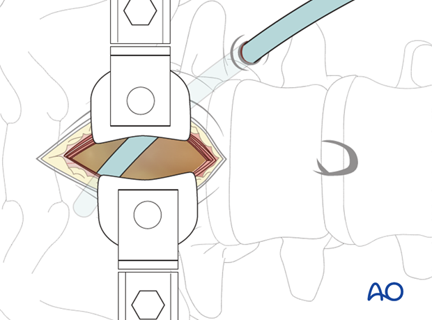 retroperitoneal approach