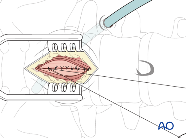 retroperitoneal approach