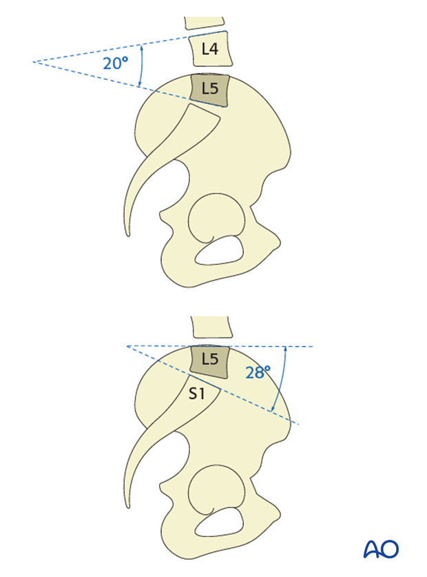 Lumbar lordosis 