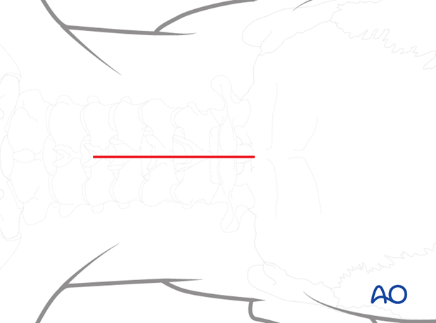 occipitocervical fusion