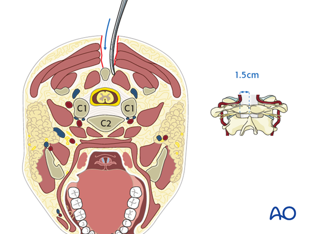 posterior access to the occipitocervical spine