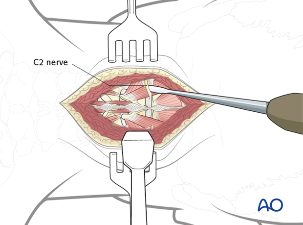 posterior access to the occipitocervical spine