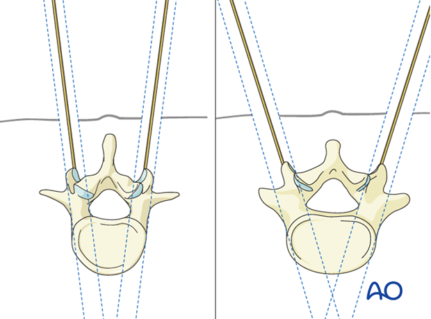 percutaneous pedicle screw insertion in the thoracolumbar spine