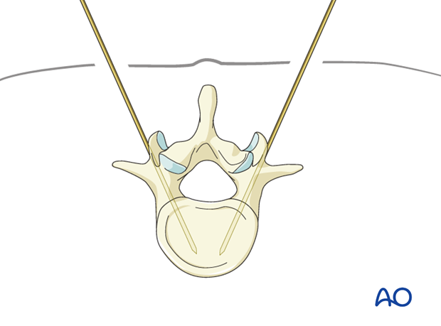 percutaneous pedicle screw insertion in the thoracolumbar spine