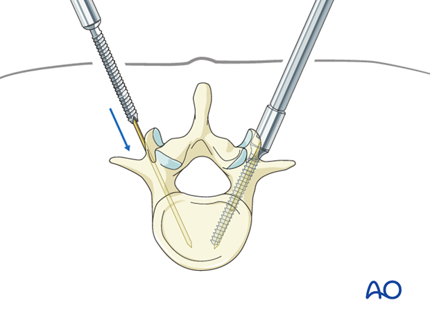 percutaneous pedicle screw insertion in the thoracolumbar spine