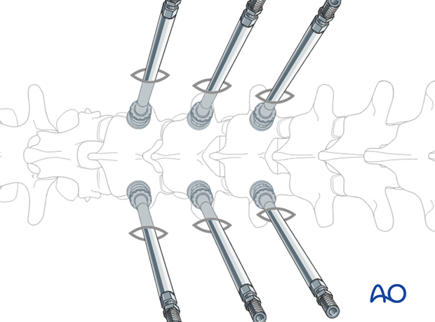 percutaneous pedicle screw insertion in the thoracolumbar spine