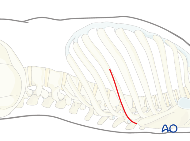 Thoracic and lumbar pathologies: Left sided thoracotomy (T3-L1/2)