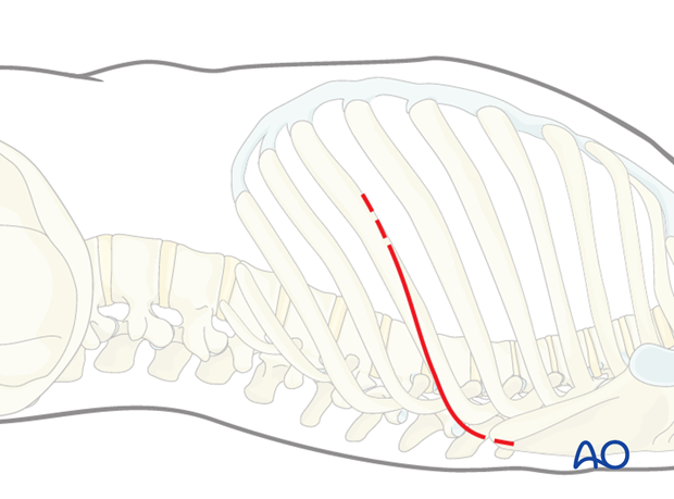 Thoracic and lumbar pathologies: Left sided thoracotomy (T3-L1/2)