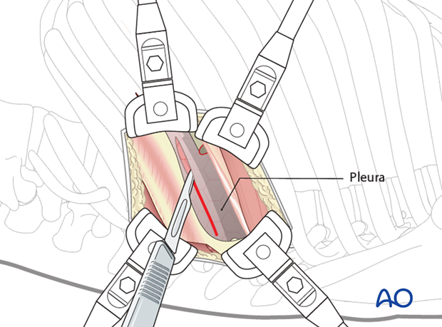 Thoracic and lumbar pathologies: Left sided thoracotomy (T3-L1/2)