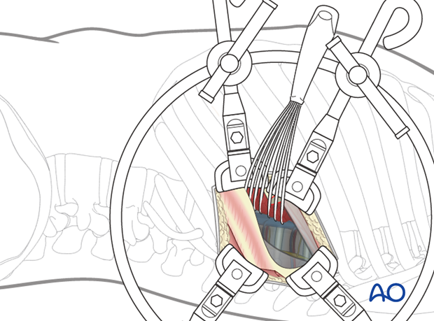 Thoracic and lumbar pathologies: Left sided thoracotomy (T3-L1/2)