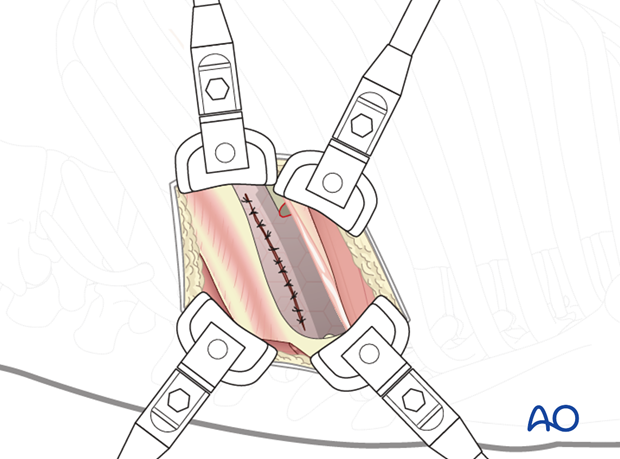 Thoracic and lumbar pathologies: Left sided thoracotomy (T3-L1/2)