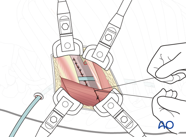 Thoracic and lumbar pathologies: Left sided thoracotomy (T3-L1/2)