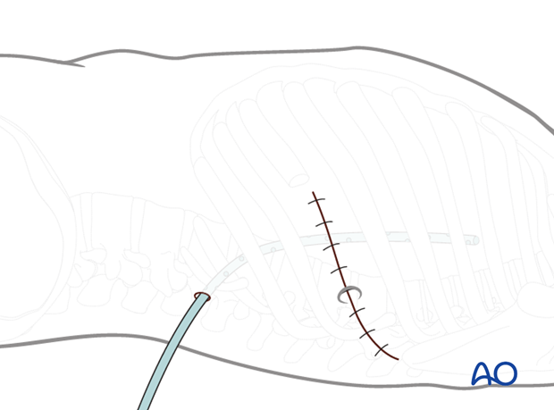 Thoracic and lumbar pathologies: Left sided thoracotomy (T3-L1/2)