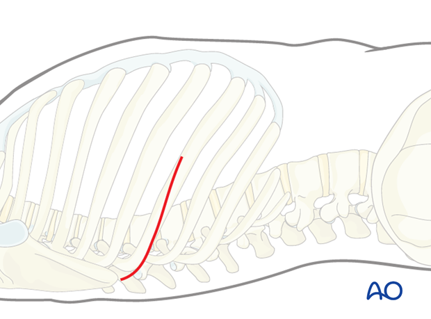 Thoracic and lumbar pathologies: Right sided thoracotomy (T3-T10)