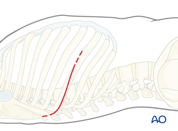 Thoracic and lumbar pathologies: Right sided thoracotomy (T3-T10)