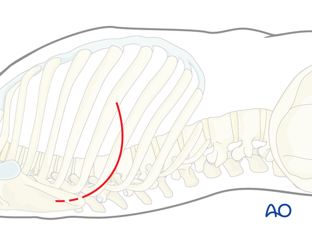 Thoracic and lumbar pathologies: Right sided thoracotomy (T3-T10)