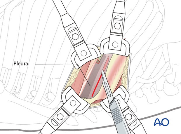 Thoracic and lumbar pathologies: Right sided thoracotomy (T3-T10)