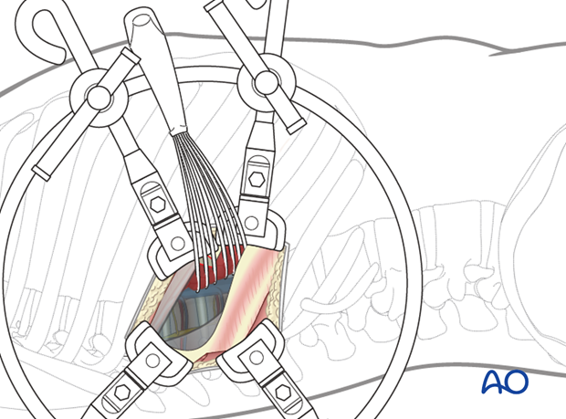 Thoracic and lumbar pathologies: Right sided thoracotomy (T3-T10)