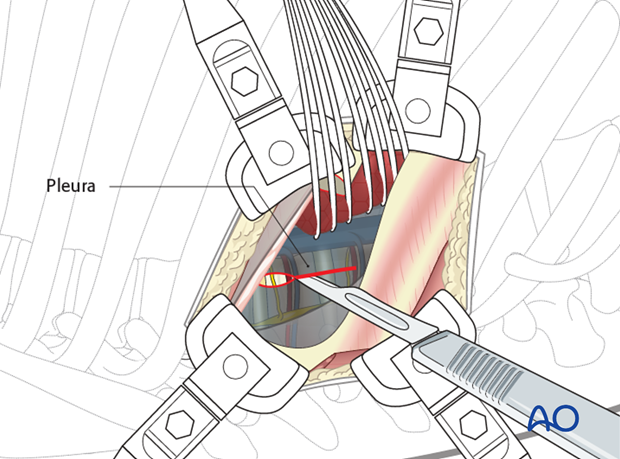 Thoracic and lumbar pathologies: Right sided thoracotomy (T3-T10)