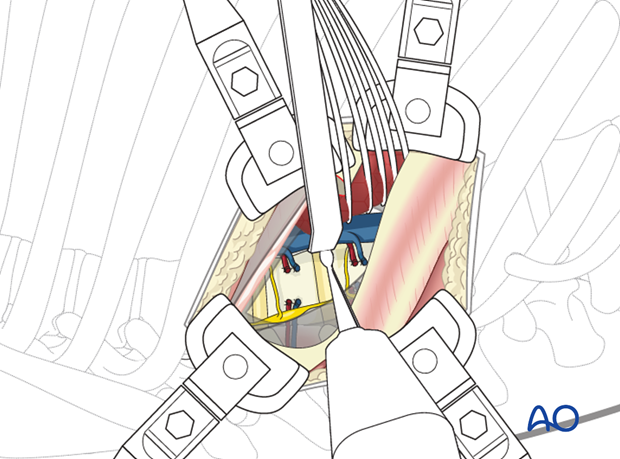 Thoracic and lumbar pathologies: Right sided thoracotomy (T3-T10)