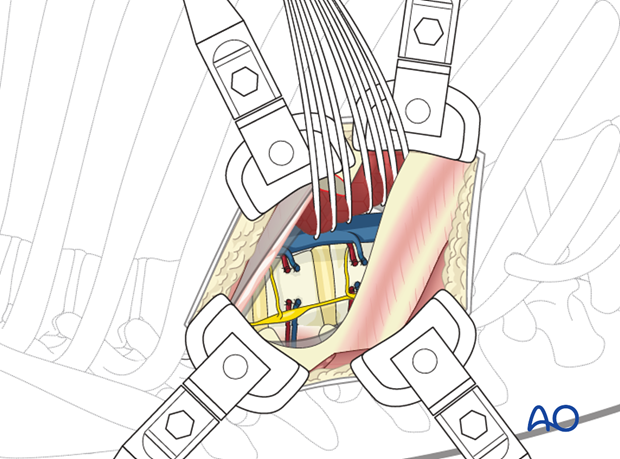 Thoracic and lumbar pathologies: Right sided thoracotomy (T3-T10)