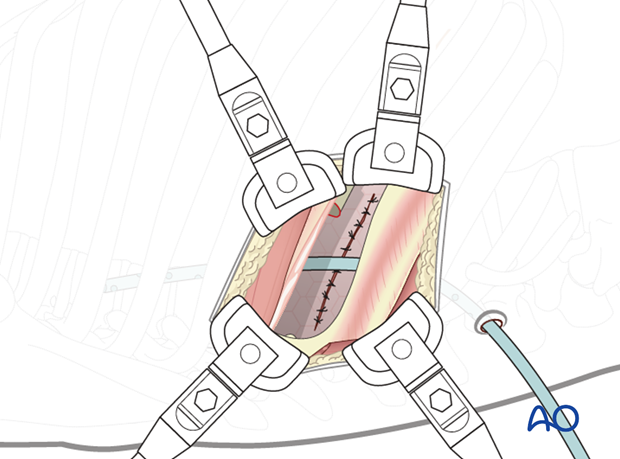 Thoracic and lumbar pathologies: Right sided thoracotomy (T3-T10)