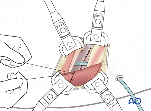 Thoracic and lumbar pathologies: Right sided thoracotomy (T3-T10)