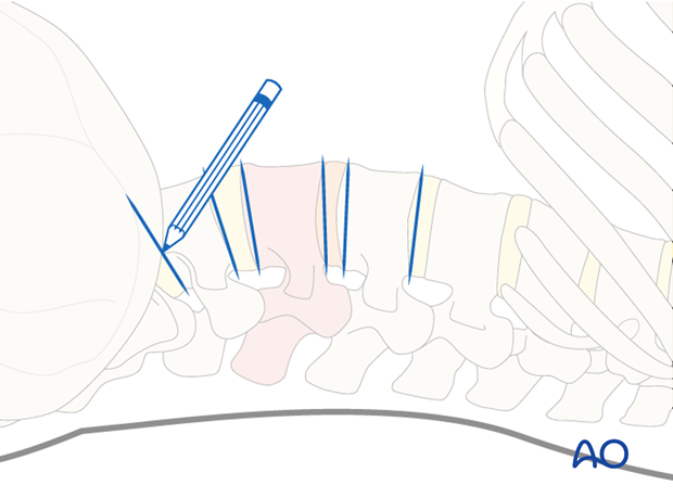 Thoracic and lumbar pathologies: Minimally invasive lumbotomy (L2-L4)